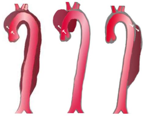 Acute Aortic Dissection