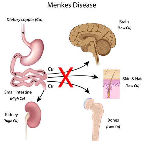 Menkes Disease Causes Symptoms Diagnosis Treatment And Prognosis