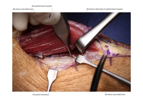 Posterior Interosseous Nerve Release Surgical Education Learn