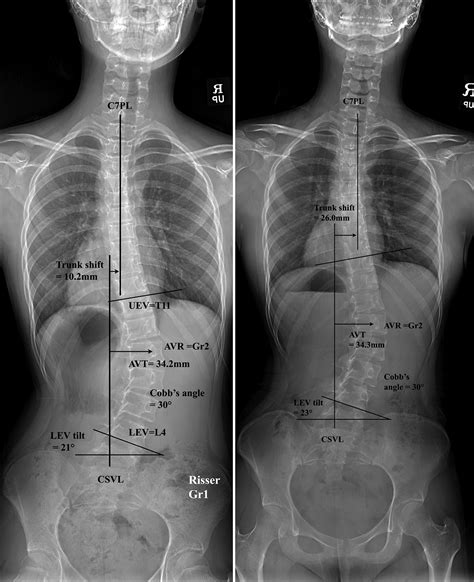 Progression Of Trunk Imbalance In Adolescent Idiopathic Scoliosis With