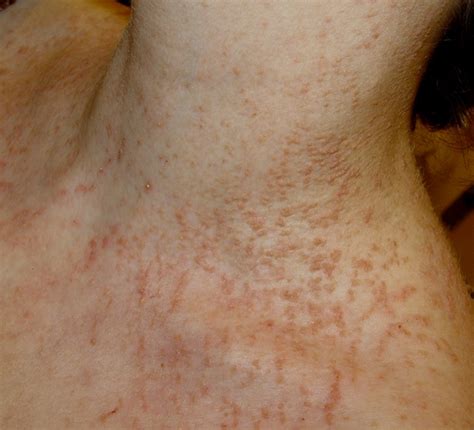 Dermatology Darier Disease