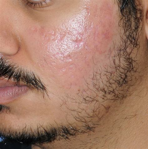 Best Tactic To Prevent And Treat Beard Acne Beard And Acne