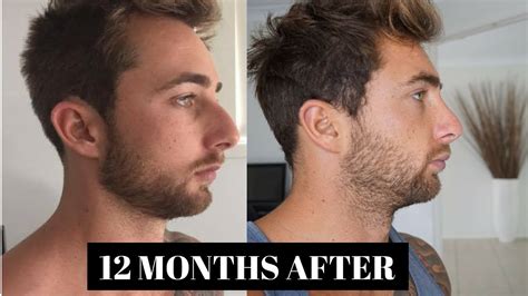 Rhinoplasty Before And After Male Debora Bull