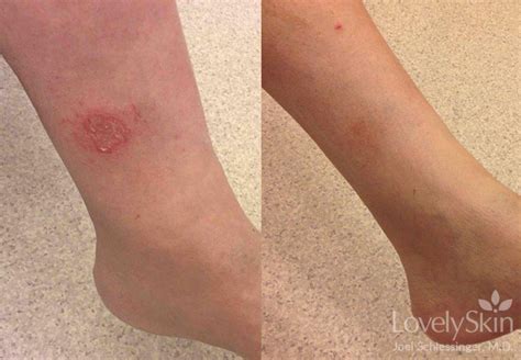 Eczema Before And After Photos Skin Specialists Pc