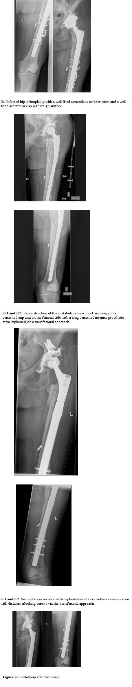 Pros And Cons Of Spacers In The Treatment Of Late Periprosthetic