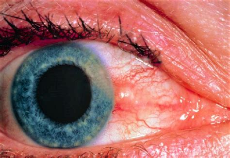 Tensi N Ocular C Mo Se Mide Y Tratamiento Oftalmolog A Laser