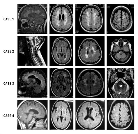 Ms Mri Brain Scan Results