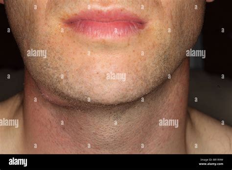 Boil Or Abscess Of The Face Stock Photo Alamy