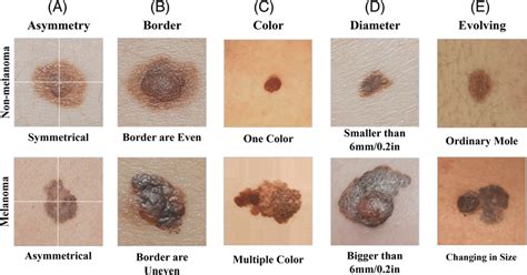 Illustration Of Abcde Criteria For Skin Cancer Detection Download