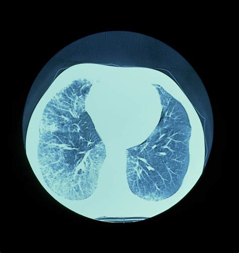 Ct Scan Of Lungs Showing Interstitial Fibrosis Photograph By Science