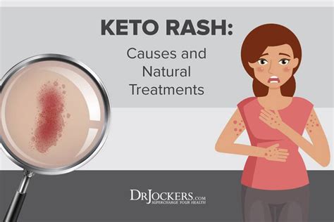 Keto Rash Causes And Natural Treatments DrJockers Com Keto Rash