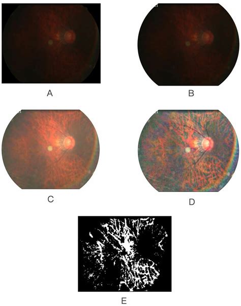 Extraction Of Fundus Tessellated Density By Artificial Intelligence