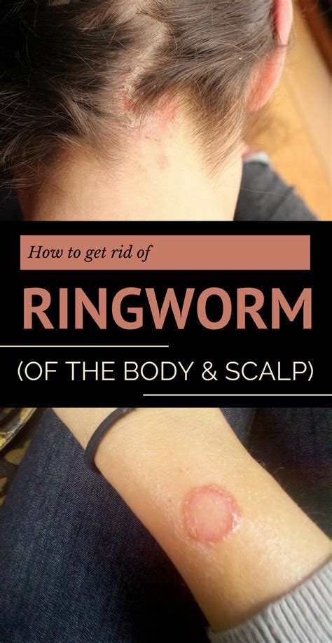 How To Get Rid Of Old Ringworm Scars Howtoremvo