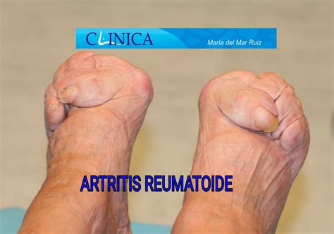 Pie Reumático Artritis Reumatoide