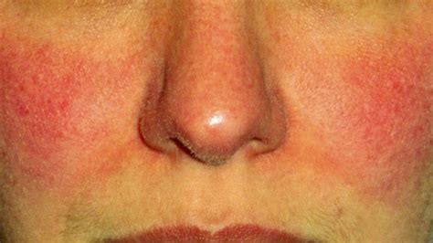Rosacea Types Causes And Remedies