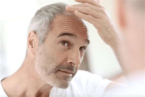 Alopecia Hair Loss Treatment Bexhill