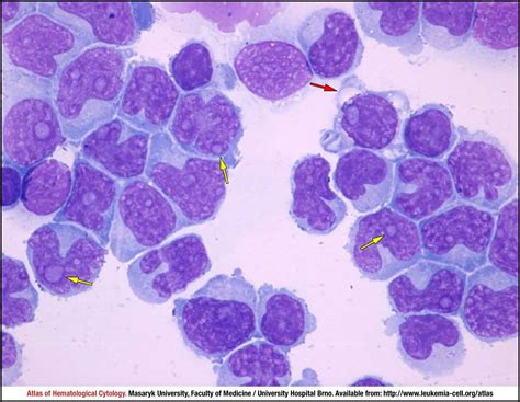 Nodal Marginal Zone Lymphoma Cell Atlas Of Haematological Cytology