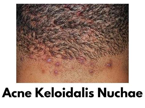 Acne Keloidalis Nuchae Removal