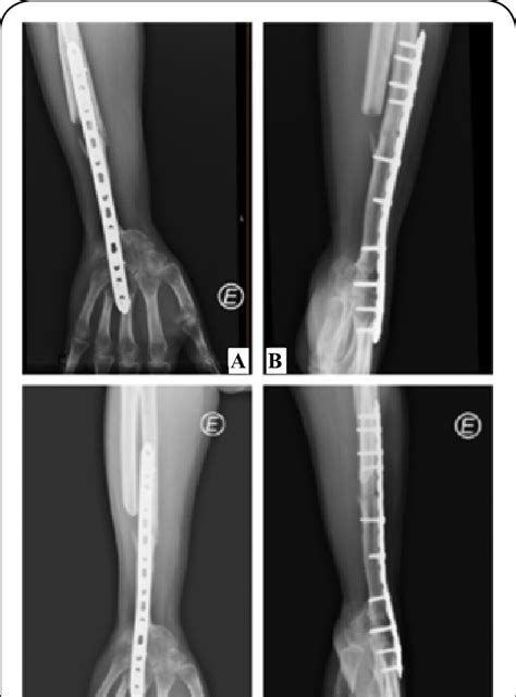 A B Ap And Lateral Radiographs At One Year Of Follow Up C D Ap And
