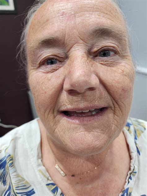 Expert Full Denture Creation in Auckland