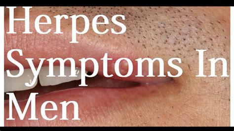 Symptoms Herpes Symptoms In Men