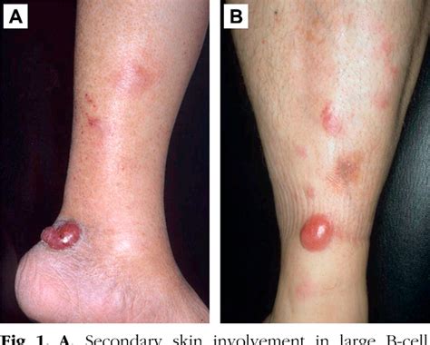 Figure 1 From Primary Cutaneous Diffuse Large B Cell Lymphoma Leg Type