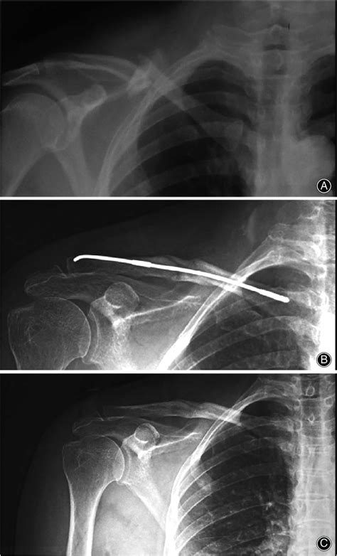 A Preoperative X Ray Showing A Patient With Mid Clavicular Fracture