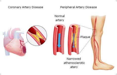 Arterial Insufficiency - Cardiovascular - Medbullets Step 2/3