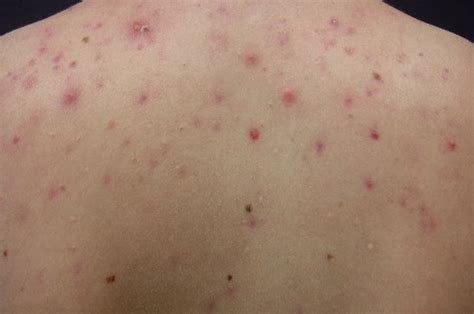 Acne On The Back 5 Reasons For Their Occurrence And How To Treat Them