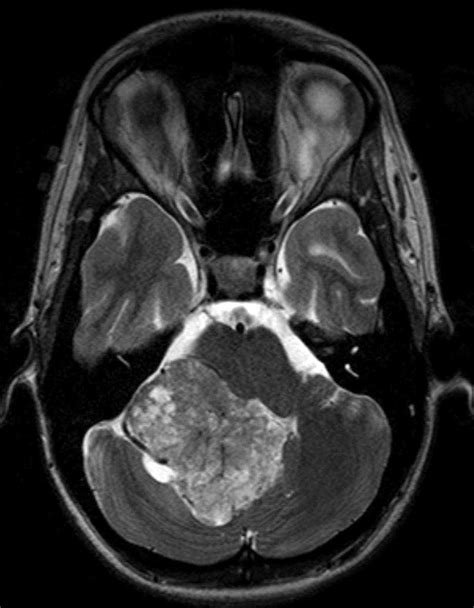Choroid Plexus Papilloma Neuro Mr Case Studies Ctisus Ct Scanning