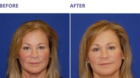 Masks come in fairly small containers, but they typically don't. Hair Restoration Hair Loss Treatment with Platelet Rich ...