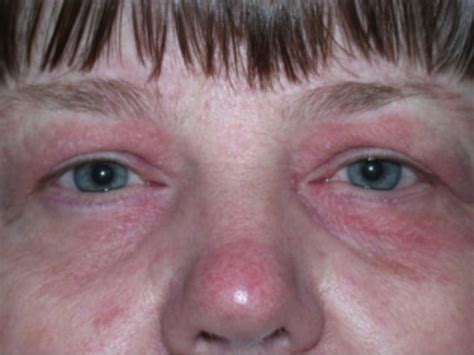 Eyelid Dermatitis Warwar Eye Group