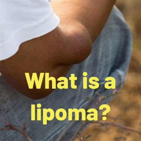 What Is A Lipoma London Shoulder And Elbow Surgeon