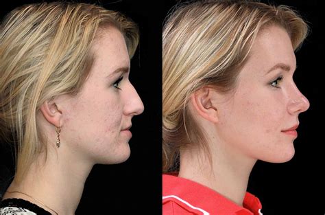 Contouring Of The Mandible Maxillary Advancement And Rhinoplasty Orthognathic Surgery