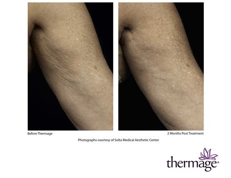 Thermage Skin Tightening Treatment Charlotte Ageless Remedies
