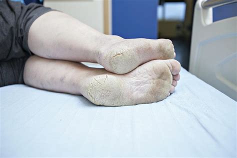 Dry Cracked Feet Diabetes Pancorekorea Com