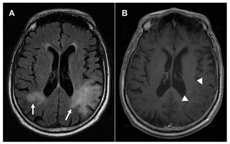 Brain Mri Shows Multiple Pml Lesions A Fluid Attenuation Inversion