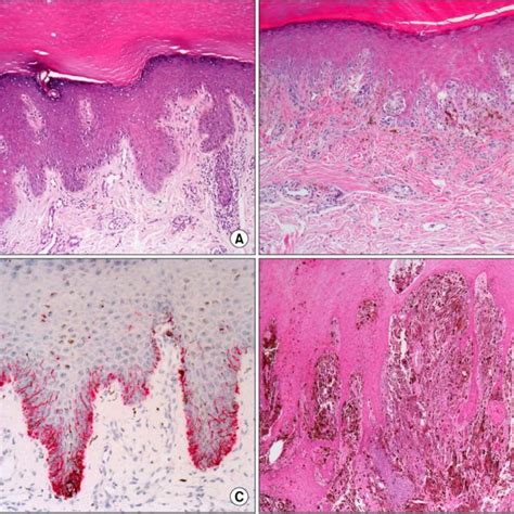 Dermoscopic Features Of Acral Melanocytic Lesions Acral Melanoma