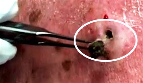 Plucking now will form a scab that might lead to another ingrown hair. Blackhead Squeezed