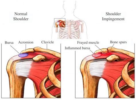 Shoulder Anterior Impingement Syndromeaka Sais