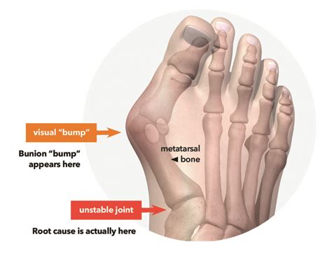 What Is A Bunion Hallux Valgus Treace Medical Concepts Inc