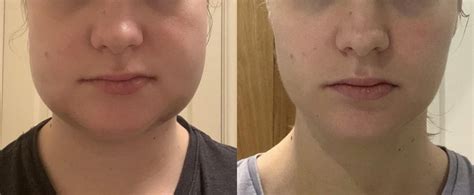 day 4 to day 9 still some asymmetry in the lips but the bulk of the swelling has gone from