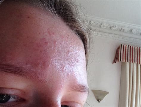 Mild To Moderate Forehead Acne General Acne Discussion