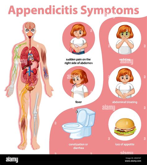 Appendicitis Symptoms Information Infographic Illustration Stock Vector
