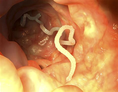 Fios Brancos Nas Fezes