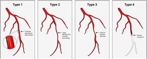 Spontaneous Coronary Artery Dissection To Do Good Or To Do No Harm