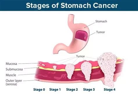 What Causes Stomach Cancer Quora