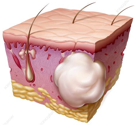 Sebaceous Cyst Stock Image C0014991 Science Photo
