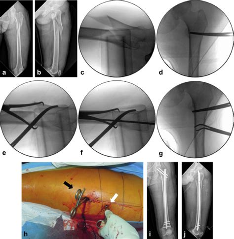Surgical Outcomes Of Minimally Invasive Cerclage Clamping Technique