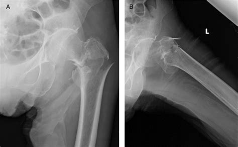 Traumatic Subchondral Fracture Of The Femoral Head In A Healed